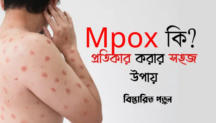 Mpox কি? এম পক্স কিভাবে ছড়ায়? প্রতিকার করার সহজ উপায় Mpox কি? এম পক্স কিভাবে ছড়ায়? প্রতিকার করার সহজ উপায়