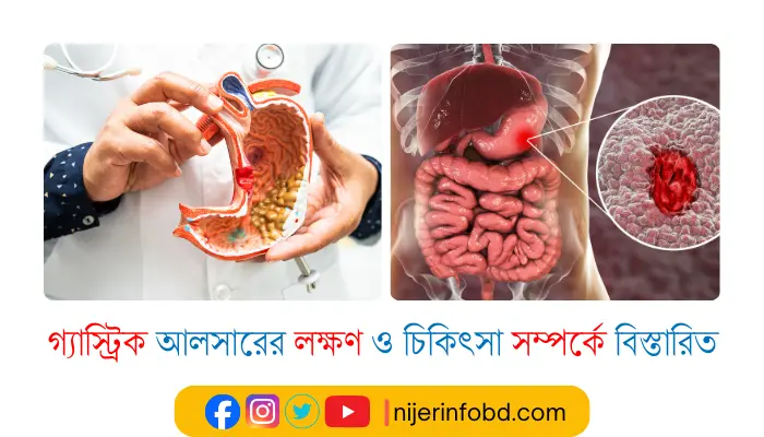 গ্যাস্ট্রিক আলসারের লক্ষণ ও চিকিৎসা সম্পর্কে বিস্তারিত গ্যাস্ট্রিক আলসারের লক্ষণ ও চিকিৎসা সম্পর্কে বিস্তারিত