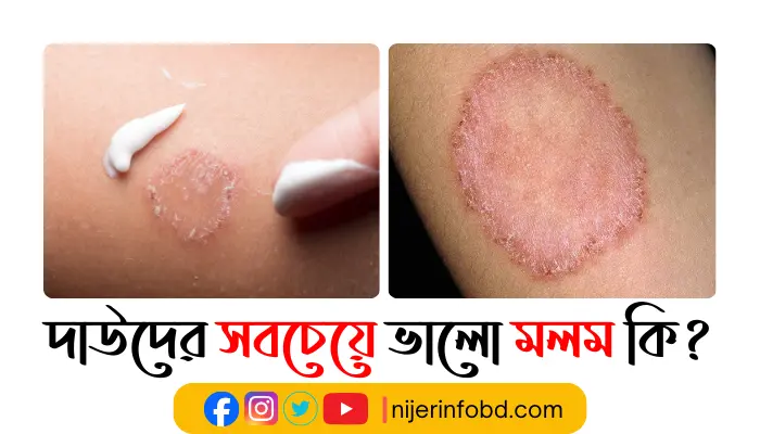 দাউদের সবচেয়ে ভালো মলম কি? ১০০% প্রতিরোধের উপায় দাউদের সবচেয়ে ভালো মলম কি?