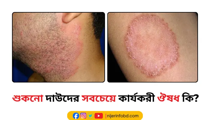 শুকনো দাউদের সবচেয়ে কার্যকরী ঔষধ কি? দাউদের চিকিৎসা শুকনো দাউদের সবচেয়ে