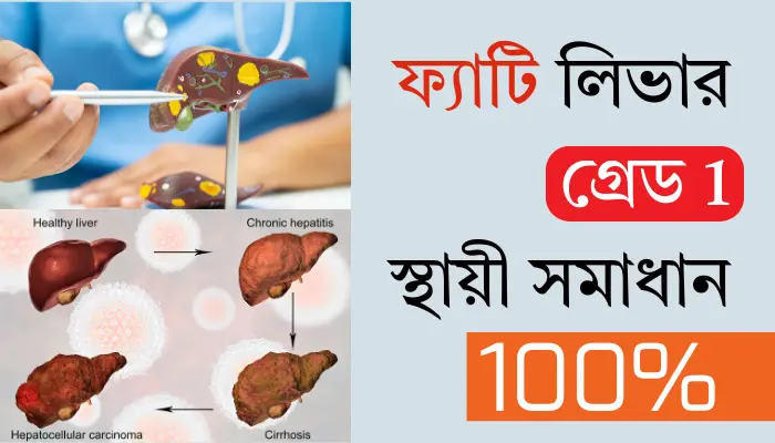 ফ্যাটি লিভার গ্রেড 1 এর চিকিৎসা ও এর ১০০% স্থায়ী সমাধান ফ্যাটি লিভার গ্রেড 1 এর চিকিৎসা ও এর ১০০% স্থায়ী সমাধান